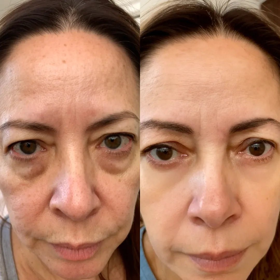 Revital Eyes® 2-in-1 Red Light Therapy + EMS To Erase Eye Bags